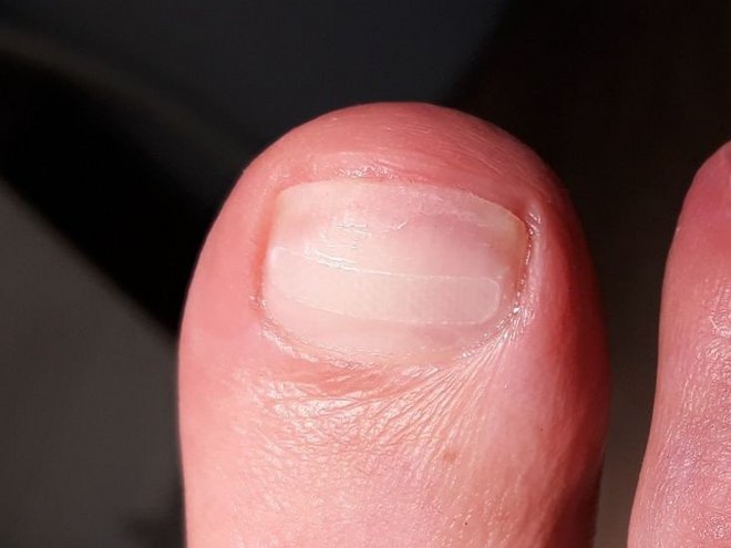 Grosszehennagel mit aufgeklebter Klebe-Nagelspange aus Fiberglas