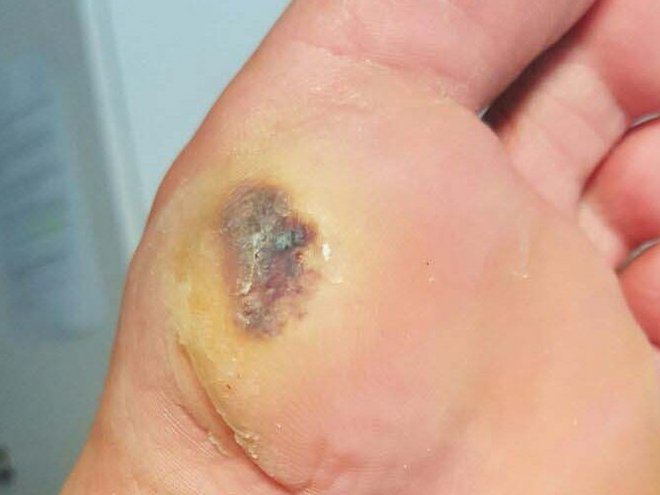 Fusssohle: gelbliche Hyperkeratose mit dunkler Einblutung unter einem Mittelfussknochenköpfchen bei Diabetes.