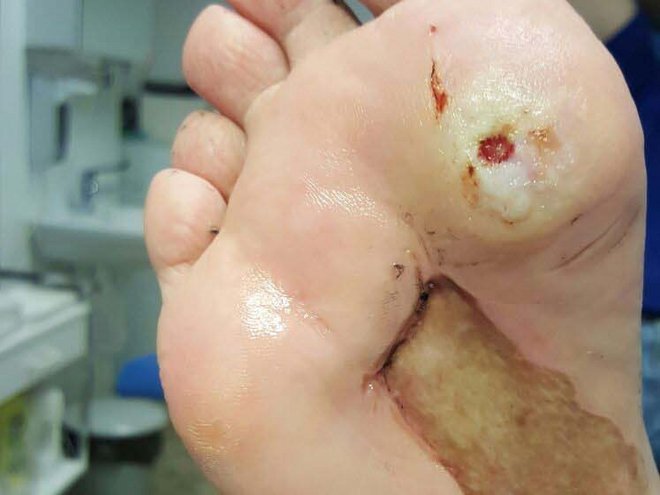 Fusssohle im Vorfussbereich nach der Behandlung: die Hornhaut ist abgetragen, die Wunde liegt frei, das verheilte Spalthauttransplantat blieb unberührt.