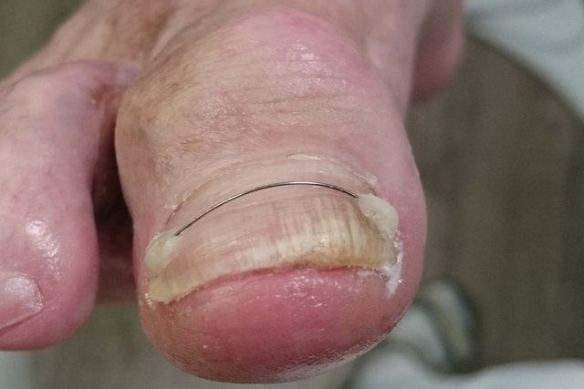 Grosszehennagel mit Titan-Nagelspange; der Titandraht liegt quer über dem Nagel