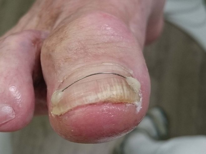 Grosszehennagel mit Titan-Nagelspange; der Titandraht liegt quer über dem Nagel