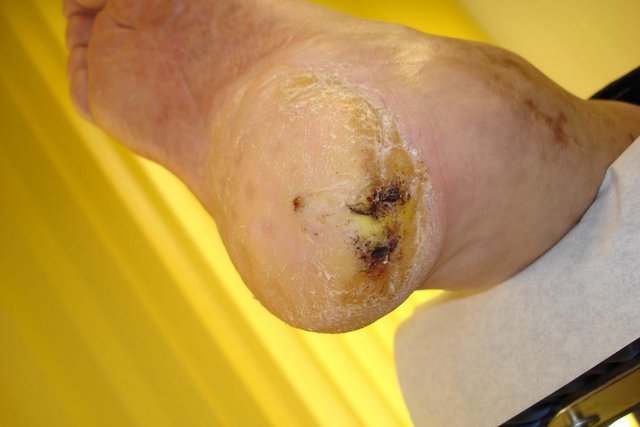 Ferse von unten: flächige Hyperkeratose mit schwarz belegter, nekrotischer Wunde am Fersenrand bei Diabetes mellitus.