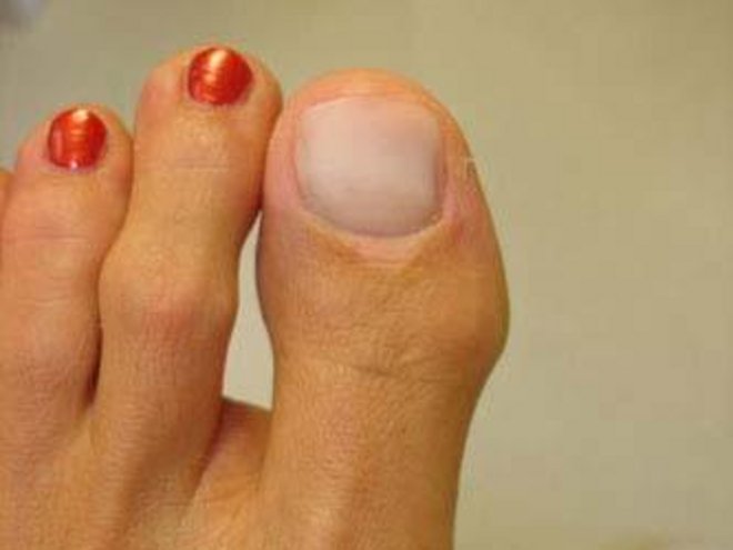 Grosszehe mit modellierter Nagelprothese; die übrigen Nägel sind lackiert