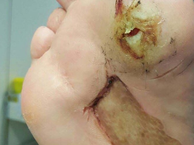 Fusssohle im Vorfussbereich: Hyperkeratose mit offener Wunde am Ballen, darunter das verheilte Spalthauttransplantat bei Diabetes mellitus.