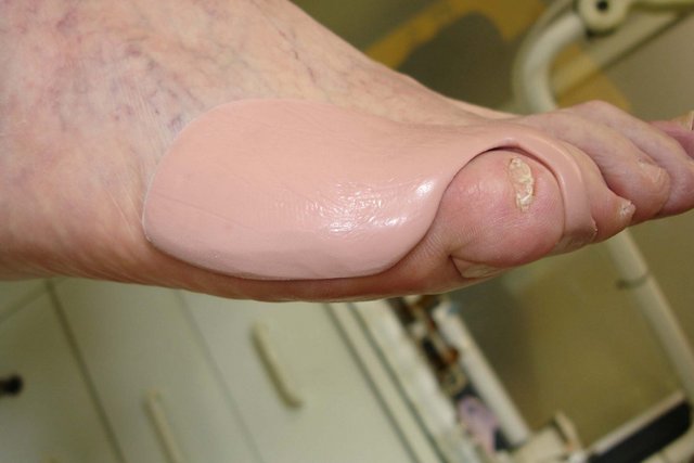 Zehen-Orthese aus Silikon am Vorfuss, die die Grosszehe von der zweiten Zehe separiert